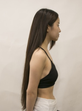 吉林現(xiàn)代整形美容醫(yī)院做假體隆胸效果怎么樣？附醫(yī)院案例效果對比圖