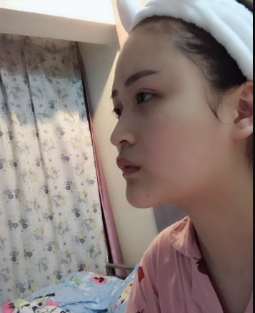 北京伊美爾美容愛康醫(yī)院醫(yī)生柳成做鼻綜合整形怎么樣？附案例效果圖