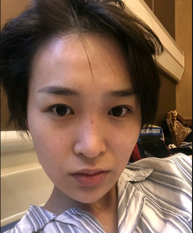武漢米蘭醫(yī)療美容醫(yī)生柳再億做眼綜合+鼻綜合整形怎么樣？附真實(shí)案例對比圖