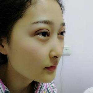 周口垣夢醫(yī)療整形醫(yī)生王濤做切開雙眼皮怎么樣？附切開雙眼皮案例效果對比圖