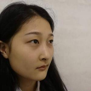 周口垣夢醫(yī)療整形醫(yī)生王濤做切開雙眼皮怎么樣？附切開雙眼皮案例效果對比圖