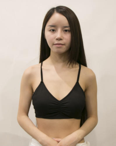 吉林現(xiàn)代整形美容醫(yī)院做假體隆胸效果怎么樣？附醫(yī)院案例效果對(duì)比圖