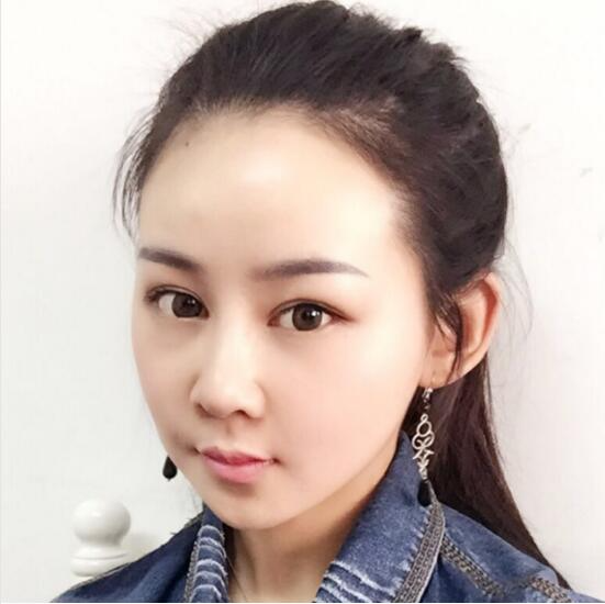 上海時光整形外科醫(yī)院醫(yī)生李靜林做假體隆鼻和反頜手術(shù)怎么樣？