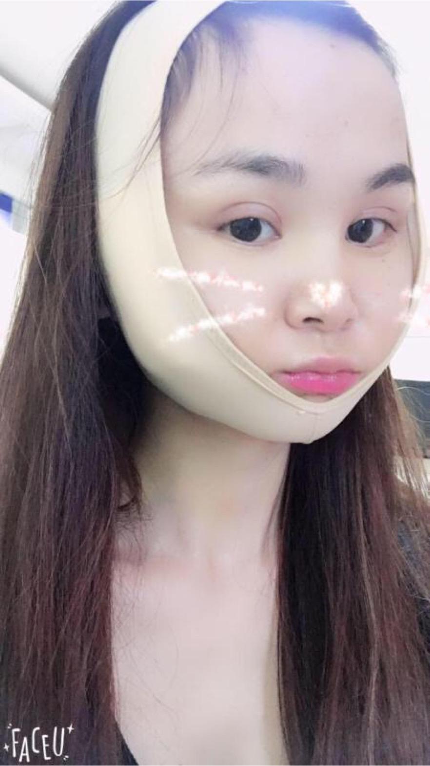 北京彤美美容整形醫(yī)院醫(yī)生楊曉惠做顴骨內(nèi)推+面部吸脂手術(shù)效果怎么樣？附案例