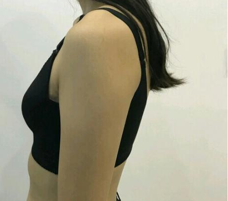 武漢伽美醫(yī)療美容醫(yī)院醫(yī)生朱富初做自體脂肪隆胸怎么樣？看案例