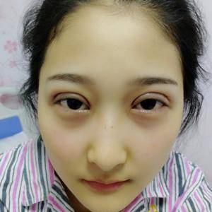 周口垣夢醫(yī)療整形醫(yī)生王濤做切開雙眼皮怎么樣？附切開雙眼皮案例效果對比圖