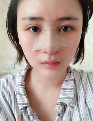 北京伊美爾美容愛康醫(yī)院醫(yī)生柳成做鼻綜合整形怎么樣？附案例效果圖
