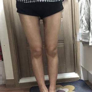 貴陽華美整形美容醫(yī)院醫(yī)生田永華做大腿吸脂效果怎么樣？附大腿吸脂案例前后對比圖