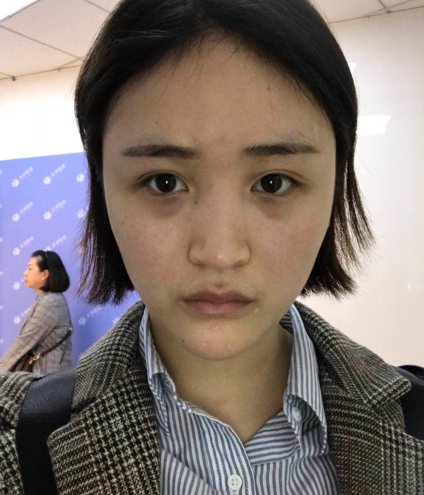 北京伊美爾美容愛康醫(yī)院醫(yī)生柳成做鼻綜合整形怎么樣？附案例效果圖
