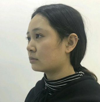 上海時(shí)光整形醫(yī)院做豐下巴怎么樣？許黎平醫(yī)生豐下巴案例分享