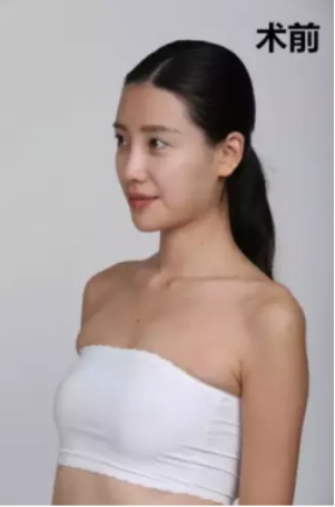 上海時光整形醫(yī)院何晉龍醫(yī)生做假體隆胸怎么樣？附案例對比圖