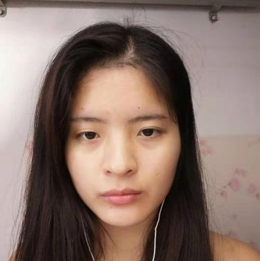 合肥韓美整形醫(yī)院做雙眼皮+開(kāi)眼角效果怎么樣?附石顯武醫(yī)生真實(shí)案例效果圖