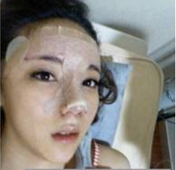 上海時光整形醫(yī)生何晉龍做假體隆鼻效果怎么樣？附案例效果對比圖