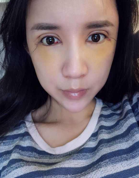 上海時光整形醫(yī)院張晶醫(yī)生做開眼角怎么樣？附真實效果圖