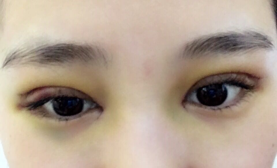 蚌埠韓美美萊整形醫(yī)生鄭捷做開眼角怎么樣？附案例效果圖