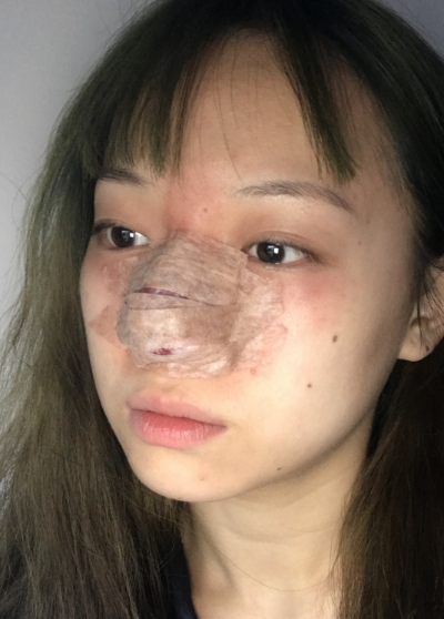 蚌埠韓美美萊整形做手術縮鼻頭效果怎么樣？附周娜醫(yī)生縮鼻頭案例效果圖