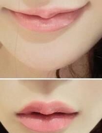 巴中時光醫(yī)學(xué)美容門診部做玻尿酸豐唇效果怎么樣？附李紅強(qiáng)豐唇案例