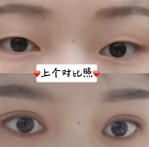 鞍山菲之都醫(yī)療整形醫(yī)院做開(kāi)眼角+全切雙眼皮效果怎么樣？附藺嬌婷醫(yī)生案例