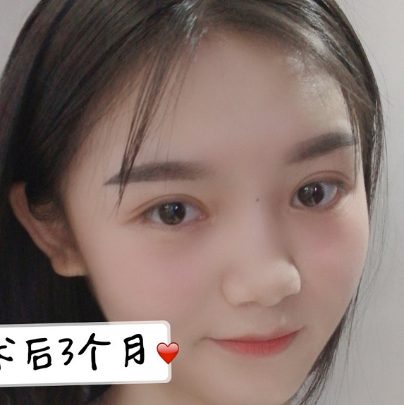 鞍山菲之都醫(yī)療整形醫(yī)院做開(kāi)眼角+全切雙眼皮效果怎么樣？附藺嬌婷醫(yī)生案例