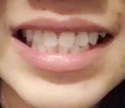 鞍山時(shí)代口腔門診部劉昕醫(yī)生做美容冠效果怎么樣？一起來看看吧