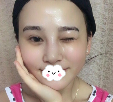 蚌埠韓美美萊整形醫(yī)生歷芳做耳軟骨隆鼻怎么樣？附耳軟骨隆鼻案例對比圖