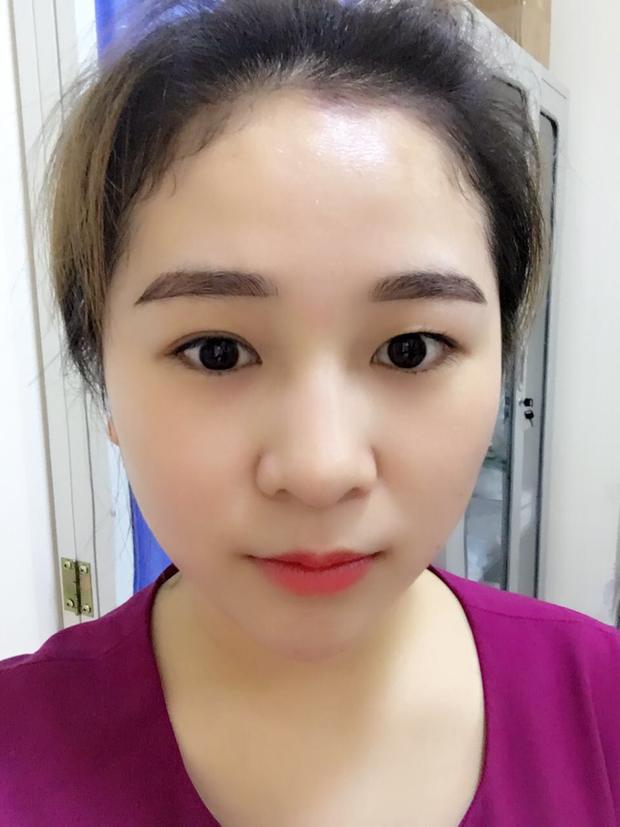蚌埠韓美美萊整形醫(yī)生鄭捷做開(kāi)眼角怎么樣？附案例效果圖