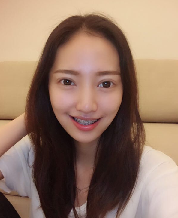 巴中華醫(yī)口腔醫(yī)院做牙齒矯正效果好嗎？附母汶靈醫(yī)生牙齒矯正案例效果圖