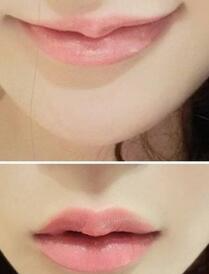 巴中時(shí)光醫(yī)學(xué)美容門診部做玻尿酸豐唇效果怎么樣？附李紅強(qiáng)豐唇案例