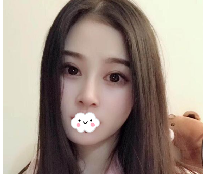 蚌埠韓美美萊整形醫(yī)生歷芳做耳軟骨隆鼻怎么樣？附耳軟骨隆鼻案例對比圖