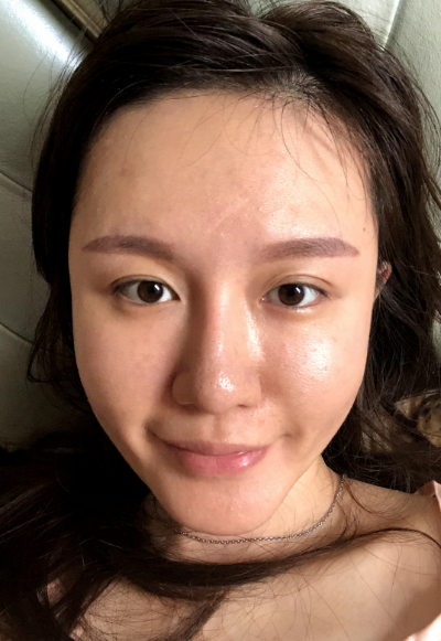 蚌埠韓美美萊整形醫(yī)生張燕做自體脂肪豐面頰效果怎么樣？附案例效果圖