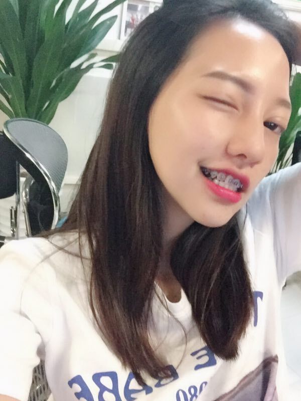 巴中華醫(yī)口腔醫(yī)院做牙齒矯正效果好嗎？附母汶靈醫(yī)生牙齒矯正案例效果圖