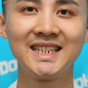 鞍山時(shí)代口腔門(mén)診部做瓷貼面案例效果圖