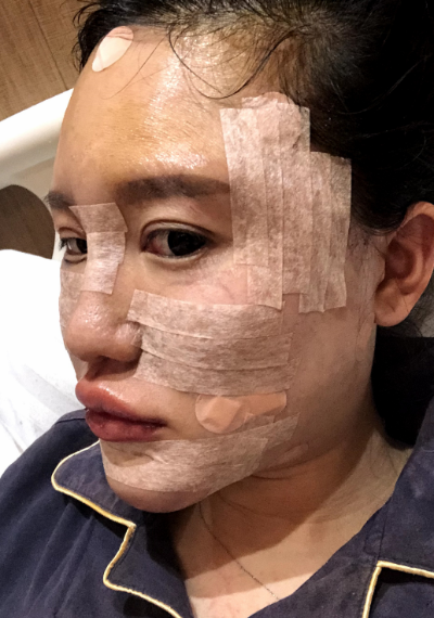 蚌埠韓美美萊整形醫(yī)生張燕做自體脂肪豐面頰效果怎么樣？附案例效果圖