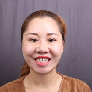 保定東陽口腔醫(yī)院趙晨醫(yī)生做瓷貼面怎么樣？附瓷貼面案例效果對(duì)比圖