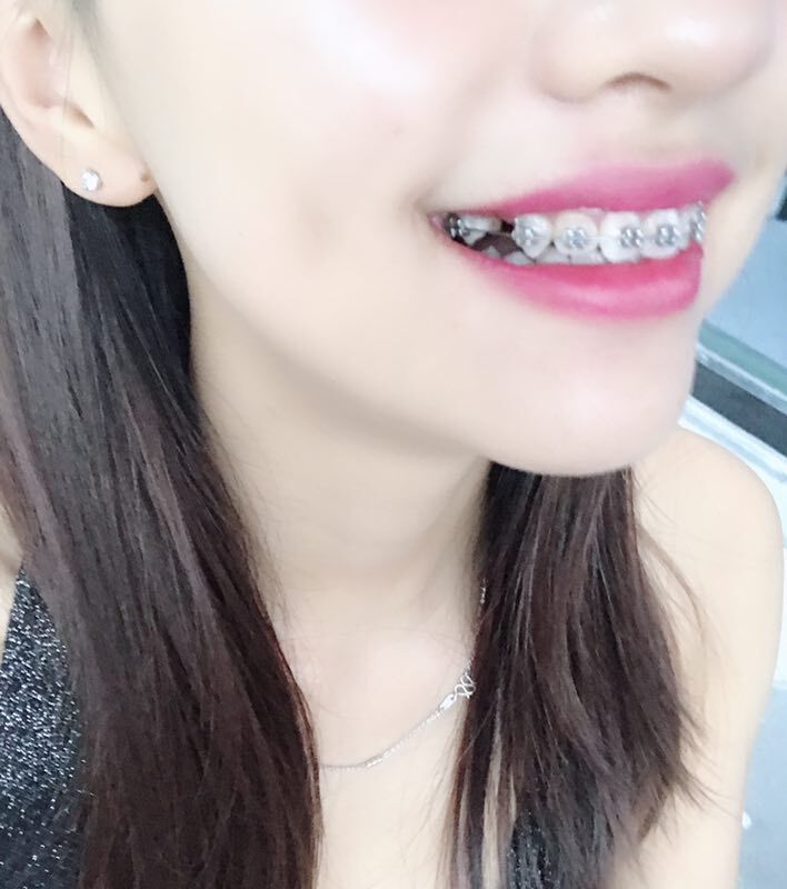保定東陽口腔醫(yī)院溫興醫(yī)生做牙齒矯正怎么樣？附牙齒矯正案例效果對比圖