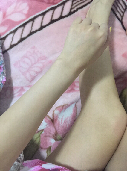 蚌埠市第三人民醫(yī)院燒傷整形科李方奇注射美白針效果怎么樣？安全嗎？附案例