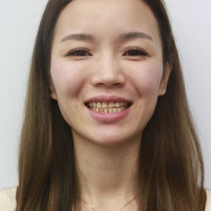 保定東陽口腔醫(yī)院興磊醫(yī)生做牙齒貼面怎么樣？附牙齒貼面案例效果對比圖