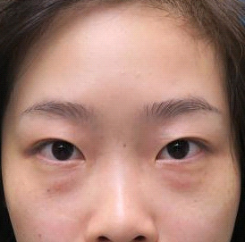 保定安卓貝拉醫(yī)療美容門(mén)診部孫大山醫(yī)生做雙眼皮+去眼袋怎么樣？附案例效果對(duì)比圖