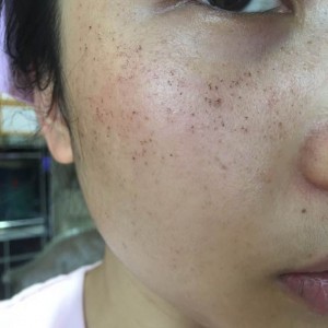 寶雞皮膚病醫(yī)院文東亮醫(yī)生做臉部祛斑效果怎么樣？附臉部祛斑案例
