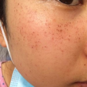 寶雞皮膚病醫(yī)院文東亮醫(yī)生做臉部祛斑效果怎么樣？附臉部祛斑案例