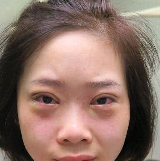 保定安卓貝拉醫(yī)療美容門(mén)診部孫大山醫(yī)生做雙眼皮+去眼袋怎么樣？附案例效果對(duì)比圖