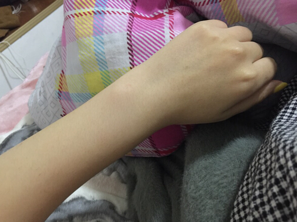 蚌埠市第三人民醫(yī)院燒傷整形科李方奇注射美白針效果怎么樣？安全嗎？附案例