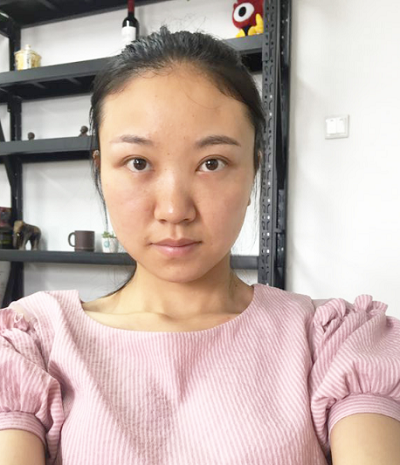 蘇州愛思特醫(yī)療美容醫(yī)院激光祛眼袋術前效果