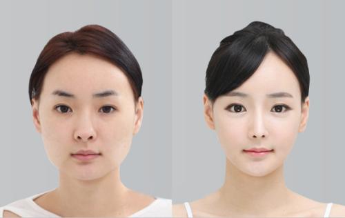 想做歐式雙眼皮，什么是歐式雙眼皮？