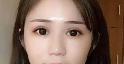 全切雙眼皮消腫的辦法有哪些？