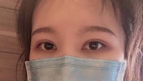 全切雙眼皮會越來越窄嗎？