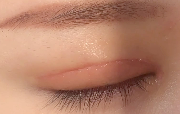 全切雙眼皮多久恢復(fù)？全切開(kāi)雙眼皮有哪些優(yōu)點(diǎn)？