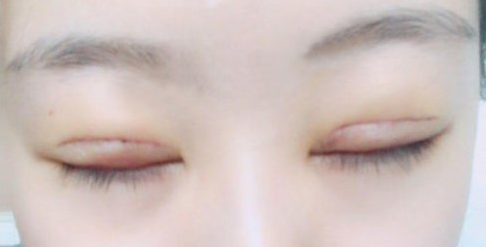 全切雙眼皮術(shù)后會留疤嗎？