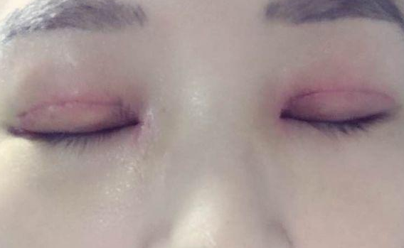 全切雙眼皮不對(duì)稱怎么辦？