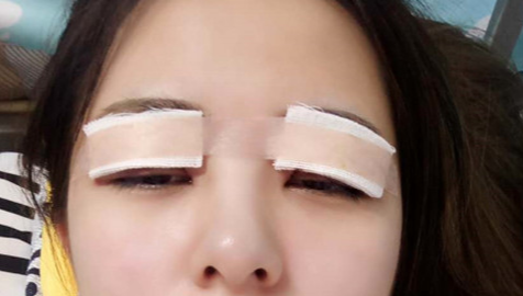 全切雙眼皮怎么恢復(fù)快？